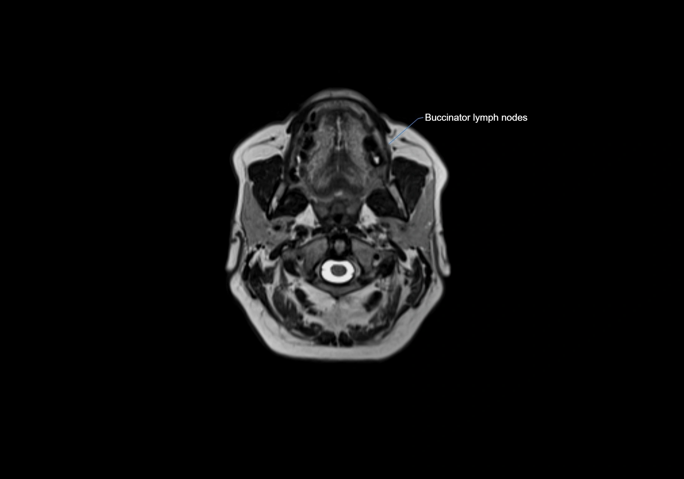 Neck axial  lymph node cross sectional MRI anatomy 3T MRI  image-img-00001-00033.webp